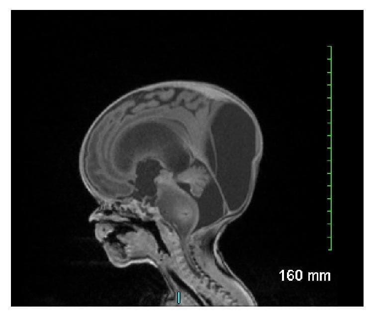 This sagittal T1-weighted fetal MRI scan demonstrates significant intracranial pathology in a developing fetus. The primary finding is a large, expansile, and poorly demarcated mass involving the brainstem, centered in the pons. The mass appears heterogeneously signal-intense and significantly expands the diameter of the pons, extending superiorly towards the midbrain and inferiorly toward the medulla. Secondary to this mass, there is evidence of severe obstructive hydrocephalus, characterized by marked dilation of the lateral ventricles and the third ventricle, with associated thinning of the overlying cerebral mantle and macrocephaly. The posterior fossa shows displacement of the cerebellar structures. This visual presentation is highly characteristic of a congenital brainstem glioma, specifically a diffuse intrinsic pontine glioma (DIPG) or similar anaplastic neoplasm, illustrating the typical obstructive complications and mass effect associated with neonatal neuro-oncology.