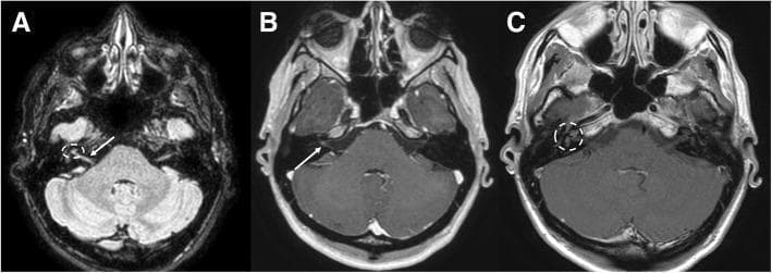 This composite diagnostic image features three axial MRI sequences of the head at the level of the cerebellopontine angle, illustrating vestibular neuritis. Image A is a FLAIR sequence showing mild hyperintensity in the cisternal tract of the right vestibular nerve (white arrow) and the right labyrinth (dotted circle). Images B and C are T1-weighted post-gadolinium sequences. Image B demonstrates pathological linear enhancement of the right vestibular nerve (white arrow) as it traverses towards the internal auditory canal. Image C highlights abnormal contrast enhancement within the right labyrinth (dotted circle). These findings are asymmetric, with no corresponding hyperintensity or enhancement on the contralateral (left) side. Such features indicate a disruption of the blood-nerve barrier and increased vascularity characteristic of inflammatory processes affecting the eighth cranial nerve and inner ear structures. The imaging is critical for differentiating between vestibular neuritis and other pathology like vestibular schwannoma or labyrinthitis.