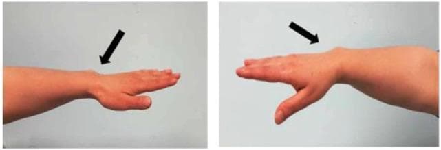 This clinical photograph consists of two side-profile views of a human forearm and wrist, illustrating the classic morphological features of a Madelung deformity. The images demonstrate a characteristic 'dinner fork' appearance caused by the dorsal subluxation of the distal ulna and the volar displacement of the hand relative to the forearm. In both panels, black arrows highlight a prominent bony protrusion on the dorsal aspect of the wrist. This skeletal anomaly is associated with bowing of the radius and an increased palmar and ulnar tilt of the distal radial articular surface. The first view shows the arm in a neutral extension, while the second view emphasizes the deformity with the hand in a more pronounced position. Such findings are hallmark clinical signs of Léri-Weill dyschondrosteosis (LWD), often linked to SHOX gene mutations. The image is intended for educational purposes in orthopedic surgery, genetics, and pediatric endocrinology to help identify dysharmonic short stature and associated skeletal dysplasias.