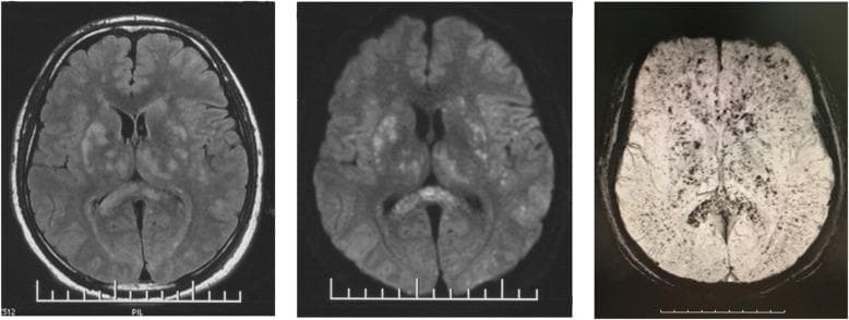 This set of axial brain MRI sequences (FLAIR, DWI, and SWI) demonstrates classic neuroimaging findings of cerebral fat embolism (CFE) syndrome following traumatic orthopedic injury. The Fluid-Attenuated Inversion Recovery (FLAIR) and Diffusion-Weighted Imaging (DWI) scans reveal numerous, small, hyperintense foci scattered throughout the brain parenchyma. This 'starfield' pattern is prominently distributed within the periventricular and subcortical white matter, basal ganglia, and deep white matter. The Susceptibility-Weighted Imaging (SWI) sequence complements these findings by showing multiple punctate hypointense spots in a similar distribution, representing microhemorrhages or susceptibility artifacts. These imaging features illustrate the diffuse embolic nature of fat particles entering the cerebral circulation, leading to multiple micro-infarcts and hemorrhagic components. The content is an essential teaching resource for distinguishing CFE from diffuse axonal injury (DAI) in the context of post-traumatic consciousness disorders and systemic clinical signs like fever and hypoxia.