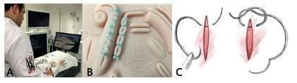 This composite educational image illustrates laparoscopic surgical training and suture techniques. Panel A depicts a clinical photograph of a trainee in a white coat operating a laparoscopic simulator. The setup includes hand-controlled surgical instruments inserted into a trainer box, with the operative field visualized on two external monitors to simulate minimally invasive surgery conditions. Panel B provides a close-up clinical photograph of a synthetic suture plate made of thermoplastic elastomer. It demonstrates practical endosuture exercises, showing parallel edges joined by evenly spaced, light blue Ethibond sutures in both continuous and interrupted patterns. Panel C is a pathophysiology diagram or instructional illustration showing the mechanical steps of creating a suture loop and knot around a longitudinal incision. The diagram highlights the proper needle angulation and thread manipulation required for secure wound closure. Collectively, these images support surgical education in laparoscopy, focusing on ergonomics, triangulation, and psychomotor skills for intracavitary suturing.