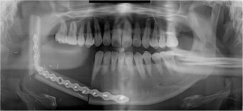 This panoramic radiograph (orthopantomogram) illustrates a postoperative view of a right mandibular reconstruction following resection. The primary reconstruction method utilizes a Fibular Free Flap (FFF), visible as a linear radiopaque bone graft extending from the right mandibular premolar region to the ascending ramus. The graft is secured by a long, contoured radiopaque reconstruction metal plate positioned along the inferior border of the mandible. The plate is fixed with multiple radiopaque cortical screws, bridging the junction between the native mandibular symphysis and the fibular graft. The fibula has been osteotomized and angled to mimic the natural mandibular contour and gonial angle. Superiorly, the reconstruction extends toward the glenoid fossa to replace the mandibular condyle. The contralateral (left) side shows intact mandibular anatomy and dentition. Key educational features include the visualization of microvascular bone flap integration, hardware placement for maxillofacial reconstruction, and the radiographic appearance of donor fibular bone used in mandibular oncology or trauma cases.