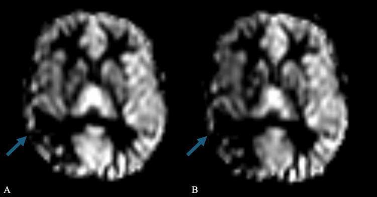 This diagnostic image displays two side-by-side axial brain MRI perfusion slices, labeled (A) Pre-Diamox and (B) Post-Diamox, used to evaluate cerebrovascular reserve. The images show a comparative analysis of blood flow within the brain parenchyma. Blue arrows point to the right middle cerebral artery (MCA) territory. In image A, the baseline signal intensity suggests existing perfusion deficits. In image B, following the administration of Diamox (acetazolamide), there is a noticeable reduction in signal intensity (darkening) in the right MCA territory compared to the baseline. This paradoxical response to a vasodilator indicates a 'steal phenomenon' or maximal baseline vasodilation with poor vascular reserve, often seen in conditions like radiation-induced cerebral vasculopathy or moyamoya-like syndromes. The educational focus is on the clinical application of Diamox-challenge MRI to assess hemodynamic compromise and the risk of ischemic events.