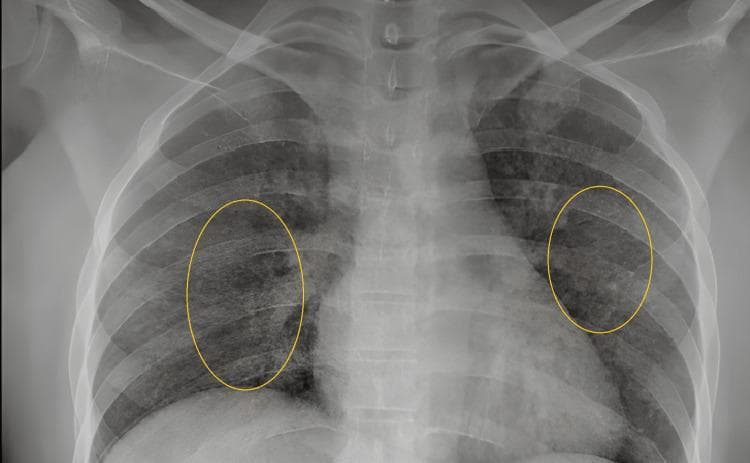 This diagnostic image is a posterior-anterior (PA) chest x-ray demonstrating classic features of miliary tuberculosis. The primary finding is a diffuse, bilateral, and symmetric distribution of small, discrete nodular opacities, approximately 1-3 mm in diameter, creating a 'miliary mottling' pattern throughout both lung fields. These millet-seed-sized nodules result in an overall granular appearance and increased density of the lung parenchyma. Yellow oval annotations highlight representative areas of the miliary pattern in the mid-lung zones. The cardiac silhouette, mediastinal contours, and diaphragmatic domes appear within normal limits without evidence of gross lymphadenopathy or pleural effusion. The visible skeletal structures, including the ribs and clavicles, show no obvious abnormalities. This radiological presentation is highly characteristic of hematogenous dissemination of Mycobacterium tuberculosis, making it a critical educational resource for understanding systemic mycobacterial disease manifestations in pulmonology and infectious disease.