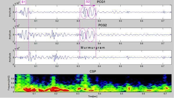 This diagnostic graphic displays cardiac acoustic data from a patient with Atrial Septal Defect (ASD). The visualization consists of four vertically aligned panels spanning a 0.7-second time frame. The top two panels show successive Phonocardiogram (PCG) waveforms (PCG1 and PCG2), identifying the first heart sound (S1) at approximately 0.05s and a clearly split second heart sound (S2) between 0.3s and 0.4s. The S2 split is highlighted with pink circles, indicating the asynchronous closure of the aortic and pulmonary valves. The third panel, labeled 'Murmurgram,' represents the subtraction of the two PCG cycles, revealing high-amplitude signal activity in the systolic interval between S1 and S2, which corresponds to a mid-systolic murmur. The bottom panel is a Cyclic Spectral Profile (CSP) or spectrogram, illustrating frequency components of the heart sounds and murmur. The murmur exhibits frequency peaks reaching approximately 400-600 Hz. This dataset serves as an educational tool for identifying the fixed splitting of S2 and the associated systolic murmur characteristic of ASD.