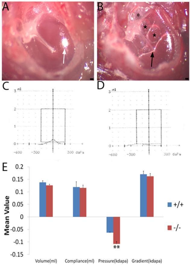 This composite educational image illustrates the clinical signs and diagnostic findings of otitis media in a murine model. Panels A and B are microscopic photographs of the tympanic membrane. Panel A shows a healthy wild-type mouse with a translucent membrane and a sharp, subuliform light cone (white arrow). Panel B displays a mutant mouse with severe middle ear pathology, including a retracted flaccid part (asterisk), hyperemia around the malleus, significant middle ear effusion (black arrow), and visible air bubbles (star). Panels C and D provide representative tympanograms: the wild-type shows a normal Type A curve peaking at 0 daPa, while the mutant shows a Type C curve with a peak at significant negative pressure, indicating Eustachian tube dysfunction. Panel E is a bar graph comparing mean values of volume, compliance, pressure, and gradient. It highlights a statistically significant increase in negative pressure in the mutant group (p < 0.01), while other parameters remain comparable. This figure demonstrates the correlation between physical otoscopic findings and physiological middle ear function in inflammatory ear disease.