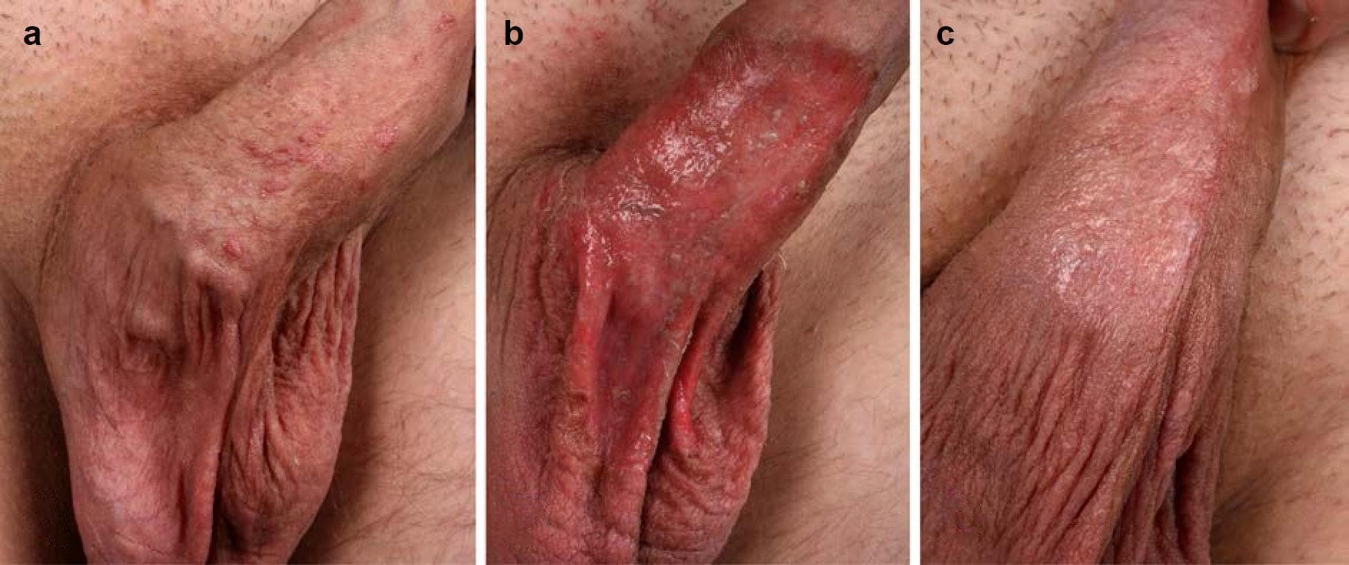 This clinical photograph sequence depicts the therapeutic progression and inflammatory response of anogenital warts (AGW) on the penile shaft treated with ingenol mebutate (IM) 0.05% gel. Panel (a) shows the baseline presentation with multiple, small, discrete, flesh-colored to slightly erythematous raised papules consistent with condyloma acuminatum. Panel (b) illustrates a severe local skin reaction 48 hours post-application, characterized by confluent, extensive erosive dermatitis. The area exhibits intense erythema, superficial tissue desquamation, and moist erosions without evidence of purulent superinfection. Panel (c) shows the clinical status four days later, demonstrating rapid wound healing and resolution of the acute inflammation. The skin displays significant reduction in erythema with early re-epithelialization and partial clearance of the original wart lesions. This series demonstrates the typical lesion-directed inflammatory response and subsequent uncomplicated healing process associated with topical ingenol mebutate treatment for genital viral lesions.