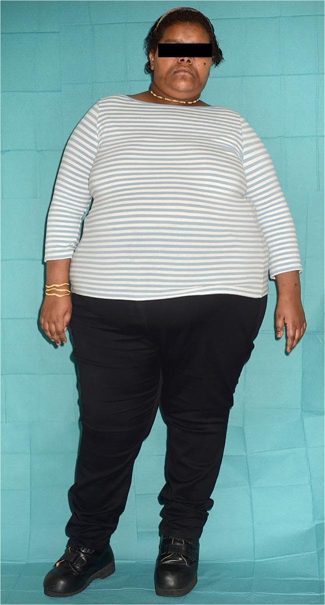 This full-body clinical photograph depicts a 20-year-old female patient exhibiting morbid obesity, with a clinical body mass index (BMI) of 51.5 kg/m". The patient demonstrates a generalized distribution of excess adipose tissue across the trunk and extremities, characteristic of childhood-onset severe obesity. The photograph is utilized in a clinical genetics context to illustrate the phenotype associated with a homozygous truncating mutation in the Carboxypeptidase E (CPE) gene. Other associated clinical findings, though not all visible, include hypogonadotrophic hypogonadism, type 2 diabetes mellitus, and intellectual disability. The patient's feet show a slight inward rotation (pigeon-toed appearance), but there is no evidence of peripheral edema. The image serves as a reference for identifying rare monogenic forms of obesity and endocrine dysfunction, specifically highlighting the systemic physical manifestations of CPE deficiency in humans.