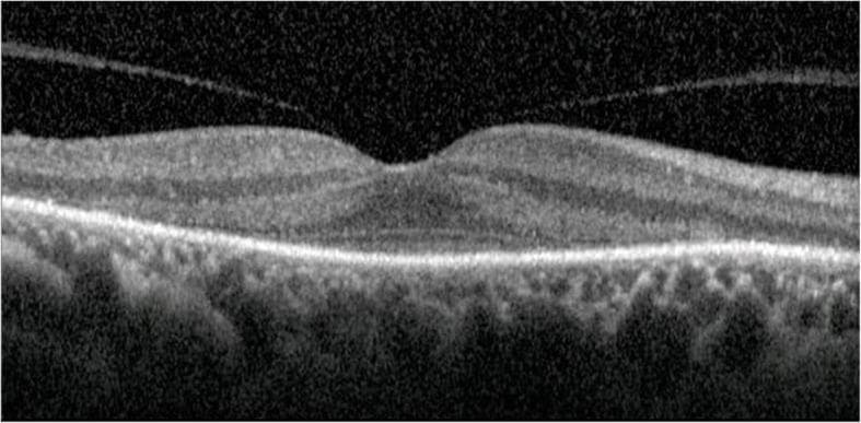 Spectral-domain optical coherence tomography (SD-OCT) of the human macula showing extensive outer retinal atrophy with characteristic foveal sparing. The diagnostic image demonstrates a progressive loss of normal retinal architecture in the extrafoveal regions, specifically the disappearance of the external limiting membrane (ELM), the inner segment/outer segment (IS/OS) junction (ellipsoid zone), the outer nuclear layer (ONL), and the outer plexiform layer (OPL). These affected layers appear thinned and disorganized with altered reflectivity. In contrast, the central foveal region maintains a relatively intact structure and distinct layering. This visual pattern is a key clinical sign often associated with cancer-associated retinopathy (CAR) or other paraneoplastic retinopathies. The OCT scan highlights the pedagogical importance of recognizing differential preservation of central vision despite diffuse peripheral outer retinal degeneration.