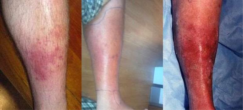 A sequence of three clinical photographs illustrating the progression of cellulitis on the lower leg, categorized by clinical severity. The 'Mild' stage (left) shows a localized, erythematous patch with poorly defined borders and scattered red papules. The 'Moderate' stage (center) demonstrates expanding confluent erythema and edema covering a larger surface area; notably, ink markings are visible on the skin to monitor the spread of infection. The 'Severe' stage (right) depicts intense, deep red to violaceous erythema involving the majority of the limb, accompanied by significant inflammatory swelling, a shiny skin texture suggestive of severe edema, and focal areas of potential skin breakdown or desquamation. This comparison highlights key diagnostic features of skin and soft tissue infections (SSTIs), including changes in color intensity, surface area involvement, and signs of tissue tension associated with worsening bacterial infection.