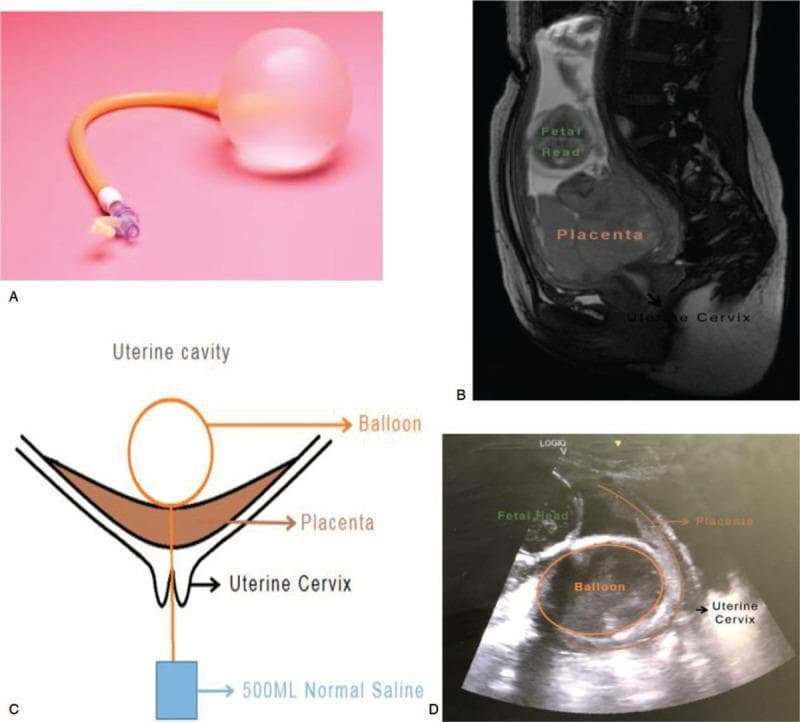 Multi-panel figure illustrating the application of a cervical ripening balloon for second-trimester pregnancy termination in cases of placenta previa. Panel A shows a clinical photograph of a single-balloon catheter with a translucent, spherical distal bulb and an orange inflation tube. Panel B presents a sagittal T2-weighted MRI of the pelvis, identifying the superior fetal head, an extensive inferior placenta overlying the internal os, and the uterine cervix. Panel C is a schematic diagram demonstrating the mechanical approach: the balloon is positioned within the uterine cavity between the fetus and the placenta, with a catheter extending through the placenta and cervix to an external 500mL saline weight for traction. Panel D is a transabdominal ultrasound image confirming the intra-amniotic placement of the inflated balloon in relation to the fetal head, placenta, and cervical canal. This educational sequence details the use of mechanical pressure and traction to manage hemorrhage and promote cervical dilation when the placenta covers the cervical os.