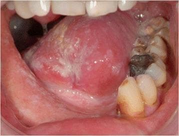 This clinical intraoral photograph displays the oral cavity 12 months following resection of an oral squamous cell carcinoma (OSCC) of the right floor of the mouth. The image highlights the postoperative and post-radiation appearance of the tongue and reconstructed floor of the mouth. The ventral and lateral surfaces of the tongue show areas of mucosal thinning, erythema, and white patches consistent with chronic post-radiation changes or scarring. The floor of the mouth exhibits altered tissue architecture and color, with generalized pallor indicative of fibrotic changes from surgical reconstruction and adjuvant therapy. The mandibular dentition is visible, showing significant dental attrition, decay, and amalgam restorations, particularly in the lower left quadrant. The surrounding gingiva and buccal mucosa appear intact but show signs of mild recession and chronic inflammatory changes. This visual serves to demonstrate long-term tissue remodeling and the clinical status of the oral cavity following radical resection, mandibulectomy, and fibular transplant reconstruction for advanced oral cancer.
