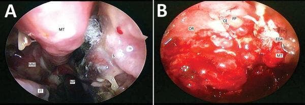 This composite of two endoscopic images (Panels A and B) illustrates advanced rhino-orbital mucormycosis. Panel A (Right Nasal Cavity) demonstrates characteristic signs of invasive fungal infection, including a thick blackish eschar containing fungal elements situated between the middle turbinate (MT) and the nasal septum (S). Localized necrosis is visible on the septum inferior to the eschar. The middle meatus (MM) exhibits significant crusting and mucopurulent discharge trickling toward the nasopharynx (NP), suggestive of secondary sinusitis. The inferior turbinate (IT) appears hypertrophic. Panel B (Left Nasal Cavity) shows more extensive tissue destruction and complications. Key findings include an extradural abscess (EDA) undergoing transnasal drainage and multiple polyps near the ethmoidal fovea (FP). There is notable destruction of the crista ethmoidalis (CE), the middle turbinate, and the orbital roof (OR) due to direct fungal invasion. These images highlight the angioinvasive nature of Mucorales, leading to hallmark features of tissue infarction, black eschar formation, and rapid destruction of cartilaginous and bony sinonasal structures in immunocompromised patients, such as those following COVID-19 treatment.
