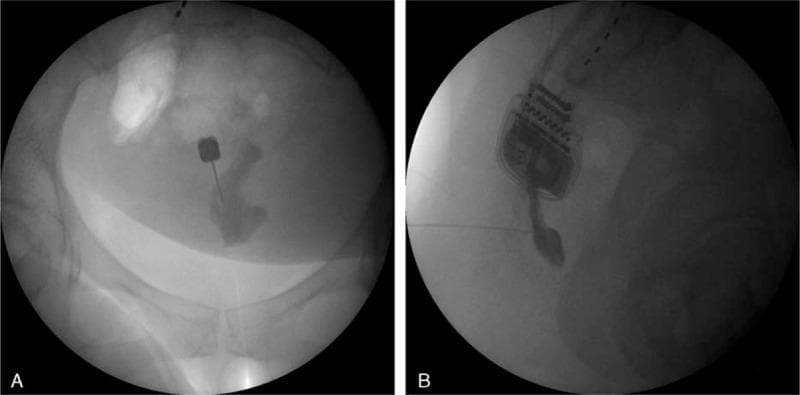 This diagnostic image displays dual fluoroscopic views (A: Anteroposterior; B: Lateral) of a ganglion impar block procedure. In Panel A, the pelvic bones and sacrococcygeal region are visible with a 22-gauge block needle inserted midline via a transsacrococcygeal approach. Following the injection of contrast media into the retroperitoneal space, an irregular radiopaque spread is noted at the needle tip. Panel B shows the lateral perspective, identifying the needle piercing the dorsal sacrococcygeal ligament with the tip positioned anterior to the ventral sacrococcygeal ligament. The contrast distribution exhibits a characteristic 'apostrophe' appearance, confirming appropriate needle placement for sympathetic block or neurolysis. Also visible in the upper field of both images is a previously implanted spinal cord stimulator (SCS) pulse generator and leads. This imagery illustrates the interventional pain management technique for treating chronic coccydynia and sympathetically maintained pelvic pain.
