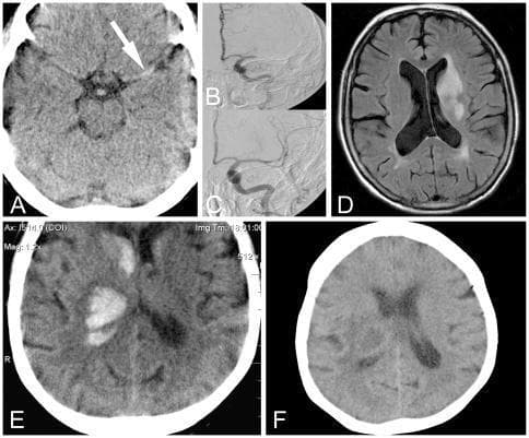 This composite of diagnostic images illustrates the neuroimaging evolution and management of ischemic and hemorrhagic strokes. Panels A-D focus on an ischemic stroke: (A) axial non-contrast CT shows a 'hyperdense middle cerebral artery' sign (arrow), indicating acute thrombus; (B) and (C) digital subtraction angiography (DSA) demonstrate proximal left MCA occlusion followed by successful intra-arterial recanalization; (D) axial diffusion-weighted MRI (DWI) at day 7 reveals a residual infarction in the left basal ganglia and periventricular white matter. Panels E-F demonstrate a hemorrhagic stroke: (E) acute axial CT shows an extensive hyperdense intracerebral hemorrhage (ICH) in the right basal ganglia with intraventricular extension; (F) follow-up CT at day 24 displays the chronic residual lesion with decreased density (hypodensity) representing blood resorption and tissue encephalomalacia. The series highlights the critical role of rapid prehospital and inpatient imaging in differentiating stroke types to guide immediate clinical interventions like thrombolysis, mechanical thrombectomy, and blood pressure management.