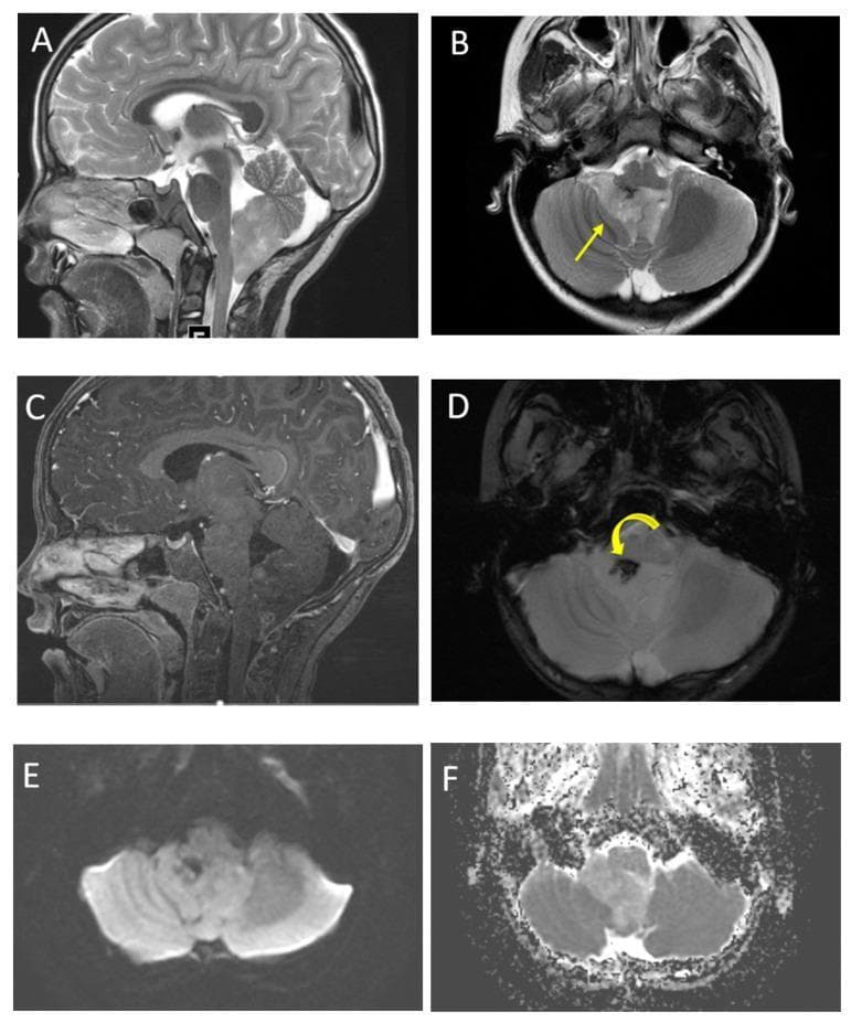 This multi-panel figure presents diagnostic magnetic resonance imaging (MRI) findings of a posterior fossa ependymoma in a 6-year-old male. (A) Sagittal and (B) axial T2-weighted images reveal a heterogeneous, predominantly hyperintense mass arising within the fourth ventricle. A characteristic visual feature is the 'plastic' extension of the tumor through the right foramen of Luschka (yellow arrow), a classic sign of ependymoma. (C) Sagittal post-contrast T1-weighted imaging demonstrates moderate, heterogeneous enhancement of the solid tumor components. (D) Axial Susceptibility-Weighted Imaging (SWI) shows a focal area of low signal intensity (curved arrow) indicating internal calcification or mineralization. (E) Axial Diffusion-Weighted Imaging (DWI) and (F) Apparent Diffusion Coefficient (ADC) map show relatively high ADC values compared to the adjacent brain parenchyma, indicating that while malignant, the tumor lacks the extreme hypercellularity seen in medulloblastoma. These images are educationally significant for identifying common pediatric brain tumor morphology, particularly the tendency for ependymomas to egress from the fourth ventricle through lateral apertures and their heterogeneous composition including cysts and calcifications.