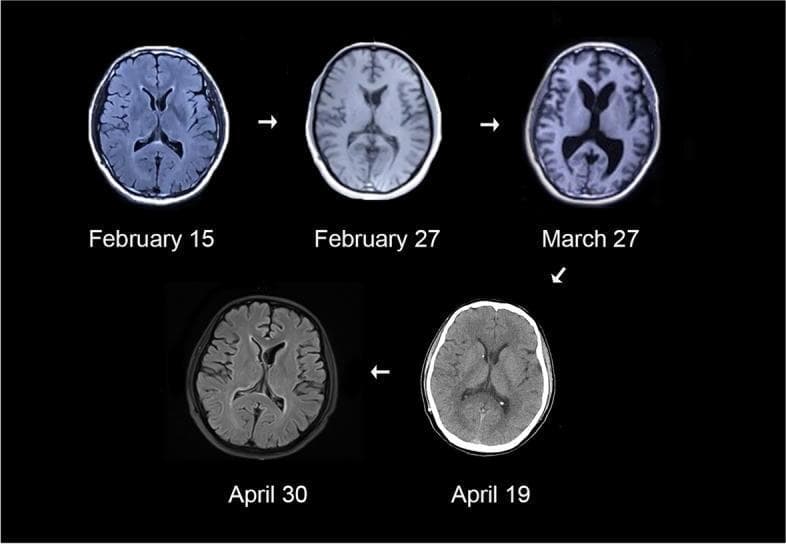 A series of five longitudinal neuroimaging studies (axial sections) demonstrating dynamic changes in ventricular size over a two-and-a-half-month period. The series primarily consists of brain MRI (T1-weighted and FLAIR sequences) and one CT scan (April 19). The images illustrate a progression from baseline ventricular morphology on February 15 to progressive ventriculomegaly by March 27, where the lateral ventricles are markedly enlarged and rounded, suggestive of hydrocephalus. Subsequent scans from April 19 and April 30 show a resolution of this enlargement, with the ventricles returning to near-baseline dimensions. This clinical progression demonstrates the fluctuation of ventricular volume, often seen in cases of intermittent hydrocephalus or following neurosurgical intervention such as shunt placement. The images provide high-contrast visualization of the cerebrospinal fluid (CSF) spaces relative to the brain parenchyma, cortical sulci, and periventricular structures, serving as a teaching tool for longitudinal monitoring of intracranial pressure-related changes.