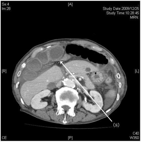 This diagnostic image is an axial (horizontal) slice from a contrast-enhanced helical CT scan of the abdomen, specifically targeting the upper abdominal region. The image demonstrates a rare case of an internal hernia. A white arrow labeled '(8)' points to a hilar defect in the falciform ligament, which is visible as a thin membranous structure in the midline. The scan reveals a strangulated distal intestinal loop herniating through this ligamentous defect. Key findings include significantly dilated, fluid-filled proximal small bowel loops positioned anteriorly and to the right, adjacent to the liver (segments S4 and S5). In contrast, distal intestinal segments appear collapsed. The liver, kidneys, and vertebral body are clearly visible, providing anatomical context. This image illustrates the pathophysiology of a closed-loop bowel obstruction caused by an internal hernia through the falciform ligament, a surgical emergency requiring prompt recognition of characteristic findings like the transition point at the ligamentous defect and associated proximal bowel dilation.