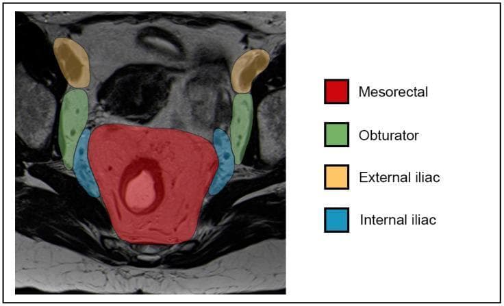 Diagnostic Image: This T2-weighted axial MR image of the female pelvis features a color-coded anatomical overlay depicting regional lymph node compartments used for oncological staging of anal and rectal cancers. The image highlights four primary regions: the centrally located Mesorectal compartment (red overlay), which displays heterogeneous signal intensity and surrounds the rectal canal; the Internal Iliac compartments (blue overlay) positioned adjacent to the lateral pelvic walls; the Obturator compartments (green overlay) located lateral and slightly anterior to the internal iliac groups; and the External Iliac compartments (yellow/orange overlay) positioned most laterally and superiorly within the pelvic field. This clinical illustration demonstrates the relevant lymphatic drainage pathways and nodal stations—specifically N1a (mesorectal, internal iliac, obturator) and N1b (external iliac) according to the 8th edition AJCC staging system. The visualization serves as a diagnostic guide for differentiating pelvic nodal anatomy in the context of pelvic malignancies like anal squamous cell carcinoma (ASCC).