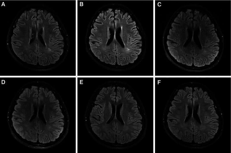 This diagnostic image series consists of six axial cranial MRI scans (labeled A to F) primarily utilizing Fluid-Attenuated Inversion Recovery (FLAIR) sequences to track the progression of Anti-NMDA receptor (NMDAR) encephalitis. In the initial scans (A and B), flaky, hyperintense (high) signal abnormalities are visible in the left parietal lobe and the periventricular white matter adjacent to the triangular regions of the lateral ventricles. Over a longitudinal timeline, scan C demonstrates a transition to speckled hyperintensities in the left parietal region. Subsequent scans (D, E, and F) illustrate a significant reduction in these signal abnormalities, showing progressive resolution of the white matter lesions. By the final follow-up scan (F), the brain parenchyma exhibits a normalized signal with no significant residual abnormal intensities. This series serves as an educational tool for neuroradiology and neurology, demonstrating the characteristic reversible white matter signal changes associated with the clinical course and treatment response of autoimmune encephalitis in a pediatric patient.
