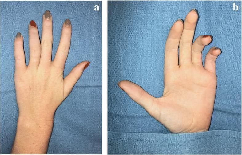 Two-panel clinical photograph demonstrating the physical manifestations of a severe, chronic ulnar nerve injury. Panel (a) shows the dorsal aspect of the hand, highlighting significant muscle wasting (atrophy) of the ulnar-innervated intrinsic muscles. This is visible as sunken, hollowed interosseous spaces between the metacarpals. Panel (b) illustrates a classic 'ulnar claw hand' deformity (main en griffe) from a palmar view. The fourth (ring) and fifth (small) digits exhibit characteristic positioning: hyperextension at the metacarpophalangeal (MCP) joints combined with flexion at the proximal and distal interphalangeal (PIP and DIP) joints. The first (thumb), second (index), and third (middle) fingers remain relatively unaffected due to their median nerve innervation. These signs are indicative of the loss of lumbrical and interossei function, leading to muscular imbalance in the hand. The clinical context suggests these findings resulted from ulnar nerve damage following an attempted Nexplanon® implant removal in the upper arm.