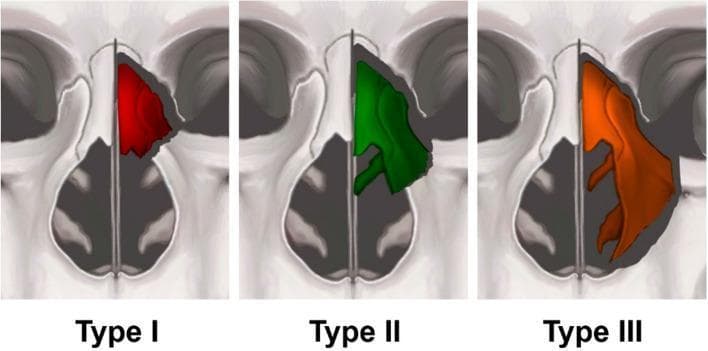 This medical illustration presents an anatomical classification of pyriform buttress fractures, categorized into three types based on the level of the fracture line and subsequent structural collapse within the nasal cavity. The diagram uses a coronal view of the midface to highlight the affected areas in color-coded segments. Type I (red) represents a high fracture line involving the upper third of the nasal pyramid, leading to collapse of the upper nasal vault. Type II (green) illustrates an intermediate fracture line passing through the bone attachment of the middle turbinate, resulting in a more extensive collapse of the upper two-thirds of the nasal vault. Type III (orange) demonstrates a low fracture line extending to the base of the pyriform rim, causing total collapse of the ipsilateral nasal wall and involving both the middle and inferior turbinates. This classification system is crucial for evaluating midfacial trauma, assessing airway obstruction, and planning surgical reconstruction in otorhinolaryngology and maxillofacial surgery.