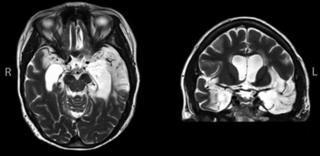 High-resolution T2-weighted Magnetic Resonance Imaging (MRI) of the brain in axial (left) and coronal (right) sections, demonstrating profound bilateral neuroanatomical abnormalities secondary to herpes simplex encephalitis. The images reveal extensive tissue loss and encephalomalacia within the medial temporal lobes and hippocampi. The damage is asymmetric, with significantly more pronounced involvement of the left hemisphere, where structural obliteration extends into the anterior temporal pole, lateral temporal regions, and fusiform gyrus. The coronal section highlights compensatory ventriculomegaly (hydrocephalus ex vacuo), particularly involving the temporal horns of the lateral ventricles, due to severe parenchymal atrophy. Large hyperintense regions on T2 imaging indicate fluid-filled cystic spaces where healthy neural tissue once resided. This diagnostic image serves as a classic illustration of the long-term sequelae of viral encephalitis, specifically the preferential destruction of the limbic system and temporal lobe structures, which clinically correlates with profound memory and cognitive deficits.