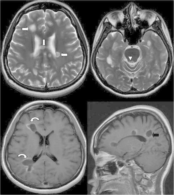 Four-panel brain MRI series demonstrating diagnostic features of Multiple Sclerosis (MS). Top row: Axial T2-weighted images showing multiple hyperintense lesions (arrows) within the bilateral periventricular white matter, the body of the corpus callosum, and the right periaqueductal grey matter (arrowhead). Bottom left: Axial T1-weighted image post-gadolinium contrast administration highlights active inflammatory demyelination, characterized by prominent ring and incomplete open-ring enhancement (curved arrows). Bottom right: Sagittal T1-weighted view reveals characteristic ovoid plaques oriented perpendicularly to the lateral ventricles, consistent with Dawson's fingers (black arrow). The imaging findings illustrate spatial and temporal dissemination according to the McDonald criteria, specifically highlighting active white matter pathology and typical anatomical distributions for central nervous system demyelinating disease.