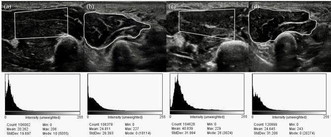 This diagnostic image displays four musculoskeletal ultrasound (US) frames and their corresponding grayscale intensity histograms, comparing the intrinsic hand muscles of a healthy control to a patient with moderate Carpal Tunnel Syndrome (CTS). Panels (a) and (c) depict the thenar muscle using a rectangular region of interest (ROI), while (b) and (d) show the hypothenar muscle with freehand traced ROIs. The visual echogenicity in the CTS patient's thenar muscle (c) appears heterogeneously increased compared to the healthy control (a). Quantitative analysis is provided through histograms below each US frame, showing pixel distribution across an intensity scale (0–255). Key metrics include Count, Mean, Standard Deviation (StdDev), and Mode. Notably, the thenar muscle in CTS (c) shows a significant rightward shift in its histogram, with a mean intensity of 40.839 compared to 20.262 in the control (a), indicating increased echo intensity (hyperechogenicity) which may correlate with denervation or fibrosis. The hypothenar histograms remain relatively similar between groups, serving as a comparative baseline. This clinical imaging demonstrates the use of quantitative grayscale analysis in evaluating muscle changes secondary to peripheral nerve compression.