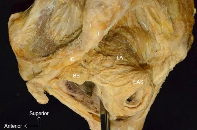 This clinical photograph displays a lateral aspect of a whole pelvis dissection, focusing on the musculature of the pelvic floor and perineum. Key anatomical landmarks are labeled: the bulbospongiosus (BS), external anal sphincter (EAS), ischiocavernosus (IC), ischial tuberosity (IT), and levator ani (LA). The image specifically demonstrates the anatomical continuity between the perineal and anal musculature, showing the muscle bundle of the bulbospongiosus (BS) attaching directly to the lateral surface of the circular external anal sphincter (EAS). Superior to these, the levator ani (LA) is visible, positioned deep to the bony ischial tuberosity (IT). The ischiocavernosus (IC) is situated anterior and superior to the bulbospongiosus. This dissection illustrates the spatial arrangement of the superficial and deep pelvic muscles, highlighting the integrated nature of the pelvic support structures and the sphincteric complex, which is critical for understanding pelvic floor functional anatomy and surgical approaches.