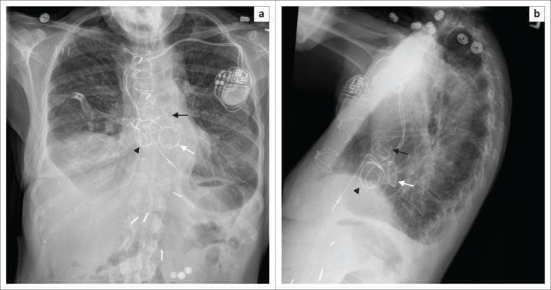Frontal (a) and lateral (b) chest radiographs of a 72-year-old female demonstrating multiple prosthetic heart valves and a cardiac implantable electronic device (CIED). Three circular, radio-opaque prosthetic valves are visible within the cardiac silhouette: the aortic valve (superior, black arrow), the mitral valve (intermediate, white arrow), and the tricuspid valve (inferior, arrowhead). In the lateral view, the aortic valve is positioned most anteriorly, while the tricuspid valve occupies the most inferior position. A pulse generator is located in the subcutaneous tissue of the left upper chest (prepectoral region) with associated radio-opaque leads coursing through the superior vena cava into the cardiac chambers, consistent with a permanent pacemaker or ICD for managing complete heart block. Median sternotomy wires are also present, indicating prior open-heart surgery. These images illustrate the radiological landmarks and spatial orientation used to differentiate valvular prostheses and cardiac rhythm management hardware.