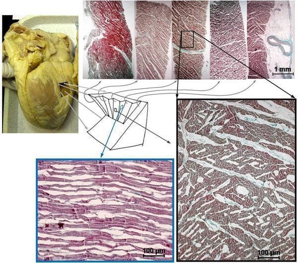 This composite educational image illustrates human myocardial histology and structural organization. At the top left, a gross clinical photograph shows a human heart with a highlighted mid-lateral block sampling site. Beside it, a series of five tangential histological slices, stained with Masson's trichrome or similar (red myocytes, blue-green collagen/connective tissue), demonstrates the laminar microstructure of the ventricular wall. These slices show varying orientations of muscle bundles and visible 'shear layers' or interstitial gaps, which may be accentuated post-mortem. A central diagram clarifies the three-dimensional planes of sectioning relative to the myocardial wall. Below, two high-magnification light microscopy frames provide a detailed comparison: the 'wall tangent section' (left) displays myocytes in longitudinal profile, revealing elongated, parallel cellular arrangements; the 'mid-wall cross-myocyte section' (right) shows myocytes in transverse cross-section, appearing as individual polygonal units separated by fine connective tissue. This figure is used in cardiology and pathology education to demonstrate the complex, anisotropic architecture of the myocardium and the transition between transmural orientations.