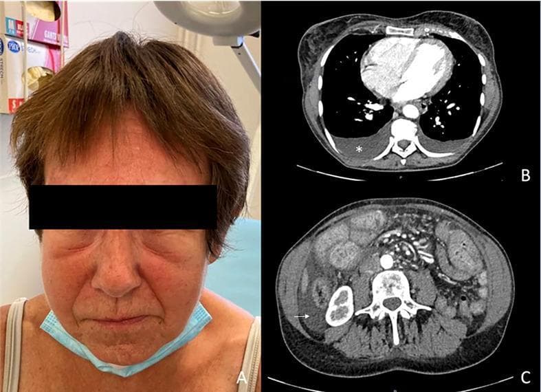 This composite medical image displays clinical signs of generalized edema (anasarca). Panel A is a clinical photograph of a patient's face showing significant facial edema, characterized by periorbital swelling, puffiness of the cheeks, and fullness of the soft tissues, leading to a narrowed appearance of the eyes. Panel B is an axial CT scan of the thorax demonstrating mild bilateral pleural effusion, visible as dependent, low-density crescentic fluid collections in the posterior pleural spaces (indicated by a white star). Panel C is an axial abdominal CT scan showing mild ascites, identified as low-density fluid surrounding abdominal viscera, with a white arrow specifically pointing to fluid in the perihepatic/paracolic gutter area. These findings collectively illustrate the multisystemic fluid accumulation associated with conditions like systemic capillary leak syndrome or profound hypoalbuminemia. The images are highly relevant for medical education concerning the physical and radiological manifestations of fluid overload and serous cavity effusions.