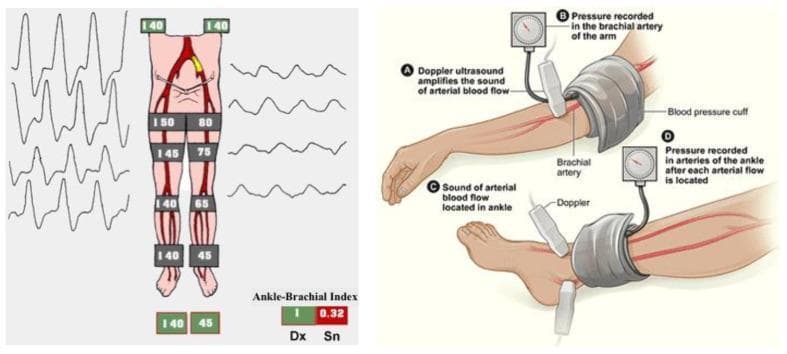 This composite educational graphic illustrates the assessment of Lower Extremity Arterial Disease (LEAD) using the Ankle-Brachial Index (ABI). The left panel presents a schematic diagram of the arterial tree in the lower limbs alongside segment-specific systolic blood pressure (SBP) measurements and arterial pulse waveforms. The right side (Dx) shows normal values (SBP 140-150 mmHg; ABI 1.0) with sharp, triphasic waveforms. In contrast, the left side (Sn) demonstrates arterial stenosis, evidenced by progressively decreasing pressures (from 80 mmHg at the thigh to 45 mmHg at the ankle), a pathologically low ABI of 0.32, and flattened, monophasic waveforms. The right panel is an anatomical illustration of the ABI measurement technique. It depicts the placement of blood pressure cuffs on the upper arm and ankle, accompanied by the use of a continuous-wave Doppler ultrasound probe to detect arterial signals in the brachial artery and the dorsalis pedis or posterior tibial arteries. The diagram highlights key steps: inflating the cuff to occlude flow and recording the SBP at the moment the Doppler signal returns during deflation.