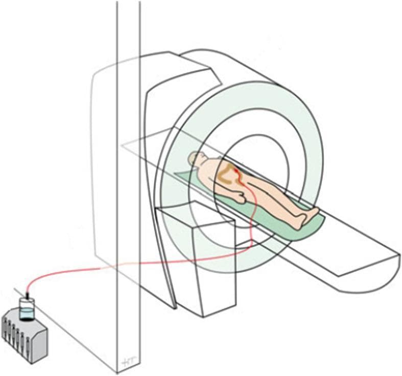This medical schematic illustrates the experimental setup for simultaneous gastrointestinal motility assessment using cine magnetic resonance imaging (MRI) and colonic manometry. The diagram depicts a patient in the supine position on the MRI scanner bed. A colonic manometry catheter is inserted into the patient's colon, represented by a red line tracing through the abdominal cavity. The catheter extends out of the MRI bore and passes through the scanner room wall to maintain a distance from the magnetic field. Outside the scanner room, the catheter is connected to a water-perfused pneumohydraulic pump and a multichannel recording system used for pressure data acquisition. The clinical significance of this setup is to allow for the concurrent correlation of intraluminal pressure changes (manometry) with visual assessment of colonic wall motion and luminal contents (cine-MRI) in the study of motility disorders, such as functional constipation or fecal incontinence.