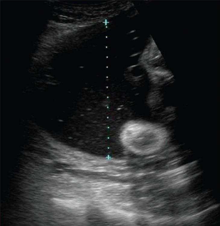 This obstetric diagnostic ultrasound image demonstrates the measurement technique for the single deepest vertical pocket (SDVP) of amniotic fluid. The primary feature is a large, predominantly anechoic (dark) area of liquor, which contains fine, low-level echogenic floating particles. These particles may represent vernix caseosa, though the differential diagnosis includes intraamniotic hemorrhage or infection (sludge). A vertical dotted line with 'plus' calipers illustrates the semiquantitative measurement of the fluid pocket, taken at a right angle to the uterine wall. In this clinical scenario, the large volume of fluid is consistent with hydramnios (polyhydramnios). Adjacent to the fluid pocket, a heterogeneous echogenic structure with a hyperechoic ring and hypoechoic center is visible, representing fetal or placental parts. The surrounding uterine and maternal tissues show varying degrees of echogenicity. This image is an educational example used in maternal-fetal medicine to teach the assessment of amniotic fluid volume and the identification of echogenic amniotic fluid.