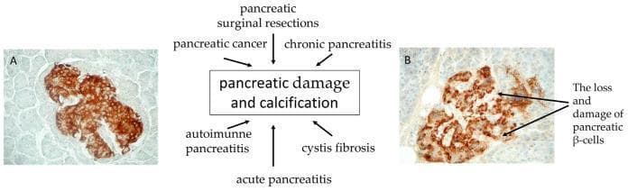 This medical figure presents a side-by-side comparison of insulin immunohistochemistry (IHC) in pancreatic islet cells, integrated with a central conceptual diagram. Image A (210× magnification) shows a normal pancreatic islet characterized by a strong, dense, and uniform brown chromogen reaction within the β-cells, indicating high insulin content and intact cellular architecture. Image B (265× magnification) depicts an islet from a patient with Type 3c Diabetes Mellitus (T3cDM), displaying a diffuse and reduced staining intensity. Arrows in Image B specifically highlight the loss and damage of pancreatic β-cells, resulting in fragmented islet morphology. Between the two micrographs, a central flowchart identifies etiologies leading to 'pancreatic damage and calcification'—including acute and chronic pancreatitis, pancreatic cancer, surgical resections, autoimmune pancreatitis, and cystic fibrosis—which ultimately contribute to the β-cell depletion visualized in Image B. This visual aid is designed for pathology and endocrinology education, illustrating the histological manifestation of pancreatogenic diabetes.