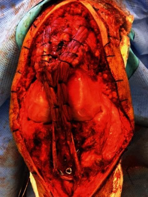 This intraoperative clinical photograph displays an open surgical reconstruction of the extensor mechanism of the knee. The surgical field reveals the anterior aspect of the knee with the patella centrally located. The image captures the 'framing' technique using a semitendinosus tendon autograft or allograft. Two distinct tendon strands are visible, having been passed through the vastus medialis and vastus lateralis muscles superiorly. These strands are then brought down and sutured to each other and around the prepatellar rim to reinforce the patellar tendon reconstruction. Interrupted sutures are visible along the graft strands, securing them to the underlying quadriceps and patellar structures. The distal portion of the graft is seen extending toward the tibial tuberosity. This procedure is typically indicated for chronic patellar tendon ruptures or cases with poor tissue quality, aiming to restore active knee extension and stable patellar tracking.