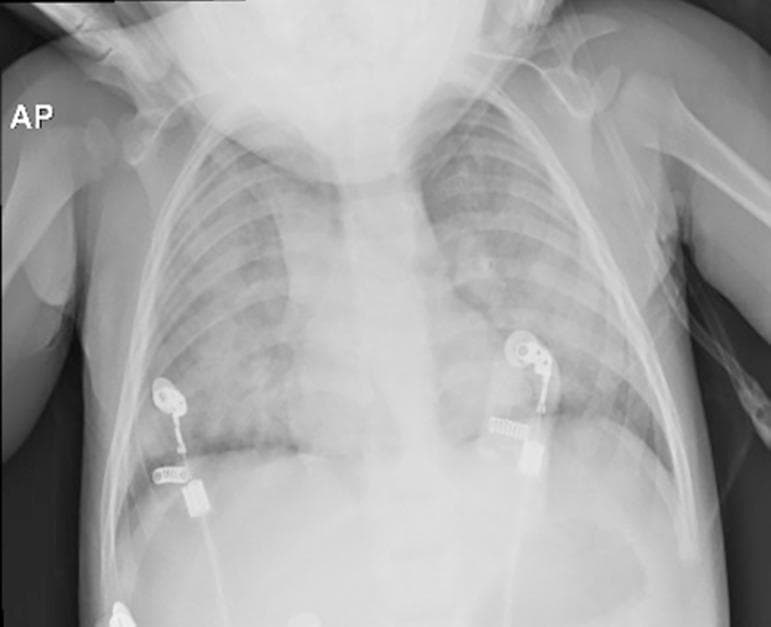 This anteroposterior (AP) chest X-ray of a pediatric patient demonstrates a diagnostic image consistent with Acute Respiratory Distress Syndrome (ARDS). The primary findings include bilateral, diffuse pulmonary opacities and areas of consolidation with ill-defined borders, indicating alveolar-interstitial involvement. The lungs appear hypoexpanded with significant increased density (haziness) throughout both lung fields, suggestive of pulmonary edema. Extrapulmonary findings include two ECG monitoring leads positioned on the lower chest and visible medical tubing. The skeletal structures and heart borders are partially obscured by the extensive pulmonary infiltrates. This image illustrates the typical radiological presentation of progressive respiratory dysfunction following traumatic injury, highlighting the clinical signs of widespread lung injury and fluid accumulation in a pediatric intensive care setting.