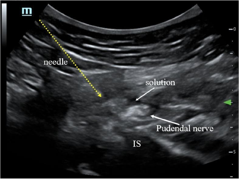 This ultrasound image demonstrates an ultrasound-guided pudendal nerve block or pulsed radiofrequency (PRF) treatment. The scan shows a cross-sectional view of the pelvic floor anatomy at the level of the ischial spine (IS). Key landmarks include the hyperechoic ischial spine (marked 'IS') providing a posterior bony boundary. The pudendal nerve is visualized as a small, mixed-echogenicity oval structure located superior and medial to the ischial spine. A needle trajectory is indicated by a yellow dotted line, originating from the top-left (in-plane approach) and terminating near the target nerve. A hypoechoic (dark) area labeled 'solution' is visible immediately adjacent to the pudendal nerve, representing the successful deposition of local anesthetic or therapeutic compound. This visual illustrates the precise placement required for regional anesthesia in the treatment of chronic pelvic pain or pudendal neuralgia, emphasizing the relationship between the nerve, the bony landmark of the ischial spine, and the therapeutic injectate.
