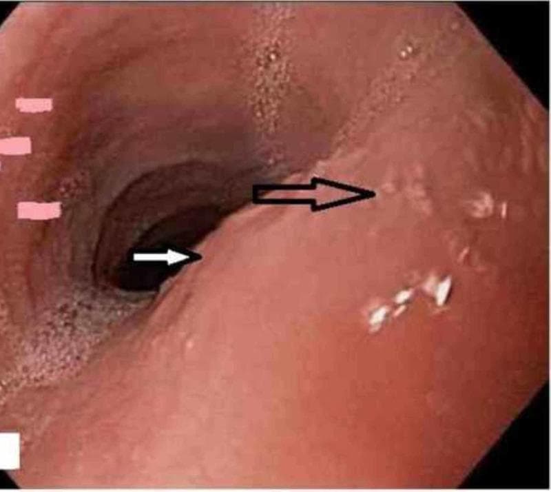 An endoscopic view of the human esophagus demonstrating hallmark features of eosinophilic esophagitis (EoE). The diagnostic image reveals a significantly narrowed esophageal lumen due to a benign-appearing stenosis, estimated at approximately 1 cm in diameter. Key diagnostic findings include the presence of multiple circumferential esophageal rings, also known as trachealization or feline esophagus, which appear as raised, concentric mucosal bands. The mucosa exhibits typical inflammatory changes, including subtle longitudinal furrowing and irregularities around the stenotic region. Black and white arrows indicate the localized area of narrowing and the distal rings. This visual evidence supports a clinical diagnosis of EoE, often associated with dysphagia and food bolus impaction. The image is categorized under Gastroenterology and serves as an educational example of structural esophageal changes related to chronic allergic inflammation.