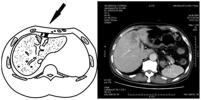 This composite educational graphic illustrates the mechanism and radiological presentation of a hepatic acceleration injury. On the left, a schematic anatomical diagram in the axial plane depicts a blunt force impact (black arrowhead) to the anterior chest wall. It demonstrates the pathophysiology where the liver is propelled posteriorly while the falciform ligament (empty arrow) acts as a fixed counterforce, resulting in shearing stress and a parenchymal laceration in the left lobe of the liver. On the right, a corresponding axial contrast-enhanced CT scan of the upper abdomen provides clinical correlation. The CT shows a clear hepatic laceration in the anterior portion of the left lobe, appearing as an irregular, hypodense area of mixed texture that disrupts the homogenous liver parenchyma. Visible surrounding anatomy includes the right lobe of the liver, spleen, stomach, vertebral body, and ribs. This material is designed to teach medical students and radiology residents about traumatic liver injuries, specifically the role of ligamentous attachments in creating shearing forces during high-velocity traffic accidents.