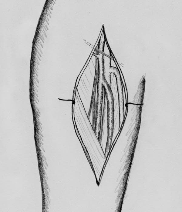 This anatomical diagram is a grayscale illustration depicting the surgical exposure of the superficial femoral artery (SFA) in the thigh, prepared for harvesting as a vascular graft. The drawing shows a vertical, spindle-shaped skin incision held open by retractors to reveal the neurovascular bundle. Centrally located within the surgical field is the superficial femoral artery, positioned between the femoral vein and the associated femoral nerve. The illustration highlights the relationship between these parallel longitudinal structures and includes fine lines suggesting surgical sutures or vessel loops used for vessel isolation. This diagram serves an educational purpose in vascular and oncological surgery, specifically illustrating the donor site preparation for carotid artery reconstruction using an autologous femoral artery transplant. Key concepts include surgical anatomy of the femoral triangle, vessel harvesting techniques, and the orientation of the femoral neurovascular sheath.