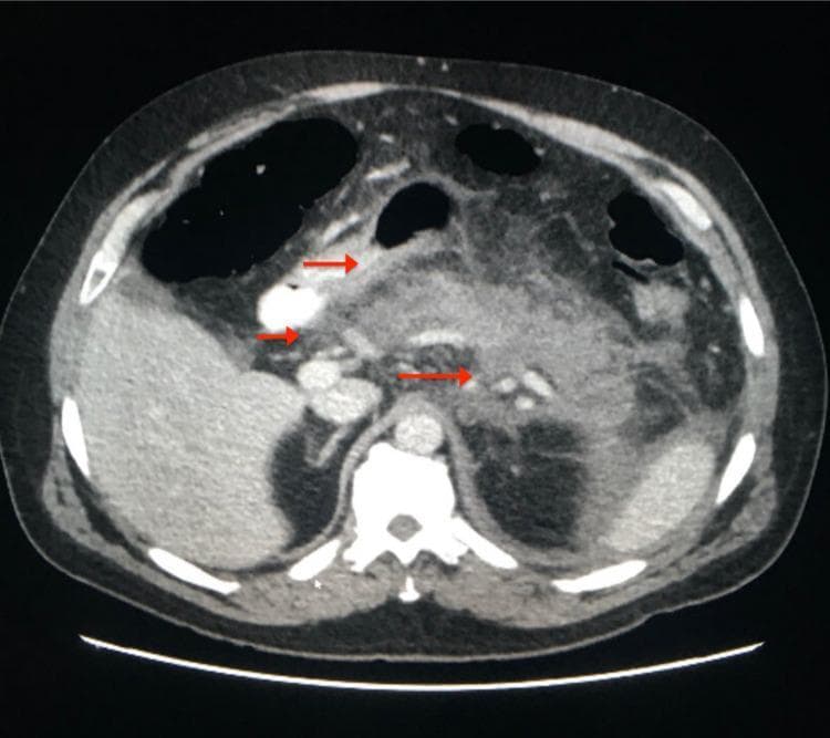 Contrast-enhanced axial computed tomography (CT) scan of the upper abdomen demonstrating findings consistent with acute necrotizing pancreatitis. The primary diagnostic feature is the diffuse hypoattenuation of the pancreatic parenchyma, indicating parenchymal necrosis. Extensive inflammatory changes are visible, characterized by prominent peripancreatic fat stranding and poorly defined tissue planes. Red arrows point to a significant, non-enhancing, homogeneous fluid collection located adjacent to the pancreatic tail and extending into the left pararenal space. The liver appears as a homogeneous, high-attenuation structure on the left side of the frame (anatomical right), while bowel loops are displaced by the inflammatory process. This diagnostic image illustrates the radiological grading of pancreatitis severity, focusing on pancreatic necrosis and associated peripancreatic fluid collections (APFC) in the early phase of the disease. The image serves as a clinical example of abdominal imaging used to evaluate complications such as infected necrosis or walled-off necrosis in gastroenterology and emergency medicine contexts.