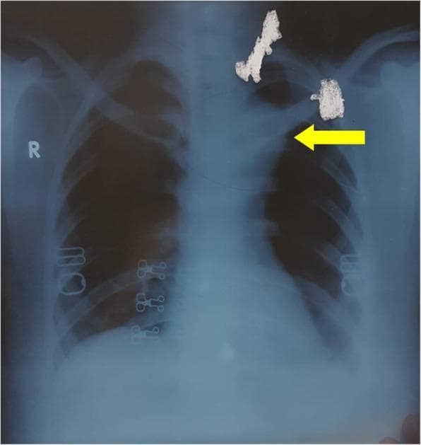 A posterior-anterior (PA) view chest radiograph (diagnostic imaging) demonstrating a significant widening of the superior and middle mediastinum. A yellow arrow points to the left-sided expansion of the mediastinal silhouette, specifically in the region of the aortic knob and descending thoracic aorta, suggesting vascular pathology such as an aortic aneurysm or pseudo-aneurysm. The lung fields appear relatively lucent, though there is some obscured detail in the left upper lobe due to the overlying mass effect of the widened mediastinum. Notable external or iatrogenic findings include irregular, highly radiopaque objects located in the superior chest and supraclavicular regions, as well as metallic surgical clips or staples visible along the lateral ribcage and paraspinal areas. This imaging serves as an educational example for identifying mediastinal mass effects and vascular emergencies in clinical radiology.