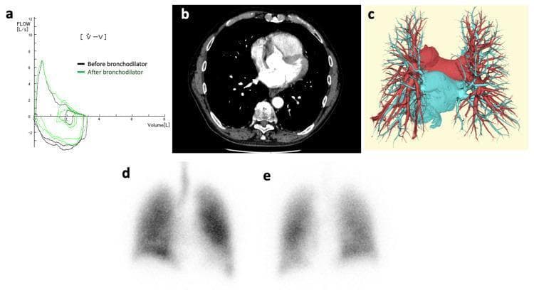 A multi-panel figure illustrating diagnostic findings in a patient with pulmonary and cardiovascular pathology. (a) A flow-volume loop (spirometry) showing a characteristic downward convex (scooped) expiratory limb indicative of obstructive lung disease, comparing pre-bronchodilator (black) and post-bronchodilator (green) states. (b) Axial contrast-enhanced chest CT at the level of the pulmonary arteries showing no acute thromboembolism. (c) Three-dimensional CT reconstruction of the pulmonary vasculature, with pulmonary arteries color-coded in red and pulmonary veins in blue; no pulmonary arteriovenous malformations or fistulas are identified. (d, e) Nuclear medicine ventilation-perfusion (V/Q) scintigraphy scans; the images demonstrate a V/Q mismatch without focal defects, suggesting a right-to-left shunt. Collectively, these images are used to evaluate platypnea-orthodeoxia syndrome (POS), focusing on identifying potential anatomical causes such as shunts or obstructive impairment.