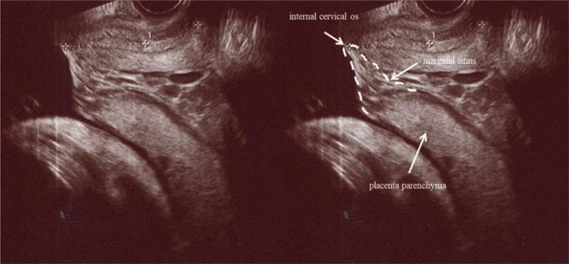 This diagnostic image consists of a side-by-side comparison of a sagittal grayscale transvaginal ultrasonography (TVUS) of the lower uterine segment during pregnancy. The right panel is annotated to identify key anatomical landmarks relevant to obstetric complications. The placenta parenchyma is shown as a homogeneous, iso-echogenic structure occupying the lower uterine segment. At the placental edge, a heterogeneous area with hypoechoic spaces is labeled as the marginal sinus. The internal cervical os is delineated by a dashed white line, demonstrating the close proximity of the placental margin and the marginal sinus to the cervical opening. This spatial relationship confirms the diagnosis of placenta previa. The imaging illustrates the use of high-resolution TVUS in the second or third trimester to evaluate placental position and identify vascular structures like the marginal sinus, which is clinically significant for assessing the risk of antepartum hemorrhage and determining delivery management in cases of low-lying or previa placentation.