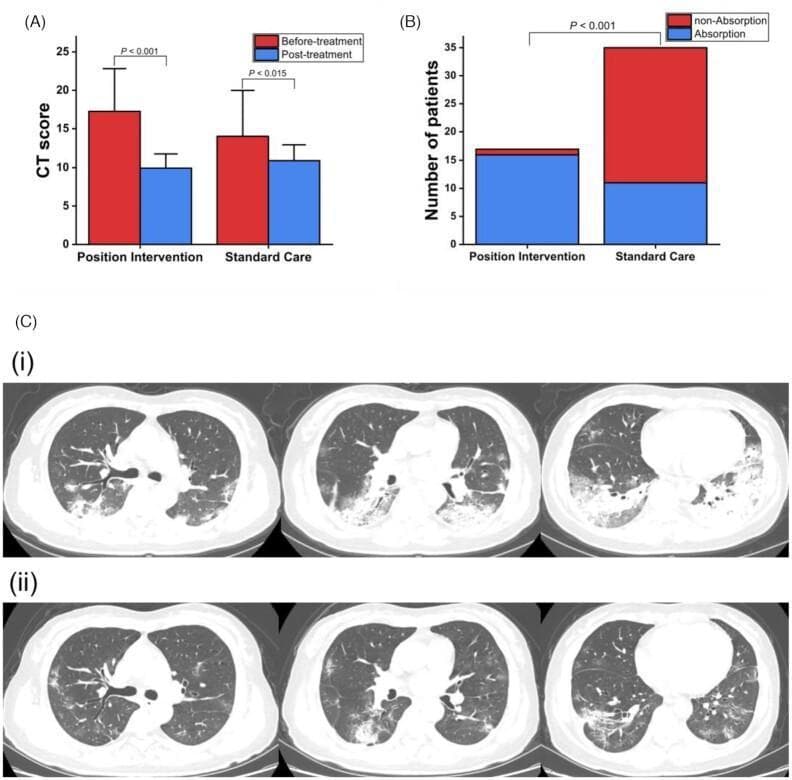 This composite educational graphic illustrates the radiographic evolution of COVID-19 pneumonia following clinical intervention. (A) Bar graph comparing Mean CT scores between 'Position Intervention' and 'Standard Care' groups, showing a statistically significant decrease in lung lesion severity post-treatment in both cohorts (P<0.001 and P<0.015). (B) Stacked bar chart showing a higher frequency of lesion absorption (>30%) in the position intervention group compared to standard care (P<0.001). (C) Longitudinal axial chest CT scans (lung window) of a 52-year-old patient. Row (i) represents the baseline state, showing bilateral, multifocal, predominantly posterior and subpleural ground-glass opacities (GGO) and consolidation. Row (ii) demonstrates follow-up imaging nine days later after prone position therapy, showing significant interval absorption and resolution of the previous consolidation and GGOs, reflecting improved pulmonary aeration. This visual resource is intended for medical education regarding diagnostic imaging in viral pneumonia and the assessment of therapeutic efficacy through quantitative CT scoring and longitudinal radiological monitoring.