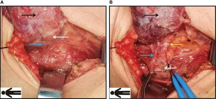 Two-panel clinical photograph illustrating the preservation of the inferior right parathyroid gland and recurrent laryngeal nerve (RLN) during a thyroidectomy surgical procedure using the Fang’s capillary fascia preservation technique. Panel A shows the operative field after raising the right thyroid lobe (black arrow), revealing the inferior parathyroid gland (white arrow) and its associated blood supply (blue arrow) in situ. Panel B demonstrates the further dissection and mobilization of tissue to protect vital structures. The sternothyroid ligament is manipulated to expose a fan-like surgical plane. Key landmarks identified include the superiorly positioned thyroid lobe (black arrow), the inferior parathyroid gland (white arrow), its distinct vascular pedicle (blue arrow), and the recurrent laryngeal nerve (yellow arrow) running in close proximity within the tracheoesophageal groove. The images emphasize the importance of identifying and maintaining the microvascular supply to the parathyroid glands and avoiding mechanical or electrical injury to the RLN during Level VI lymph node dissection. This material is intended for endocrine surgery and surgical anatomy education.