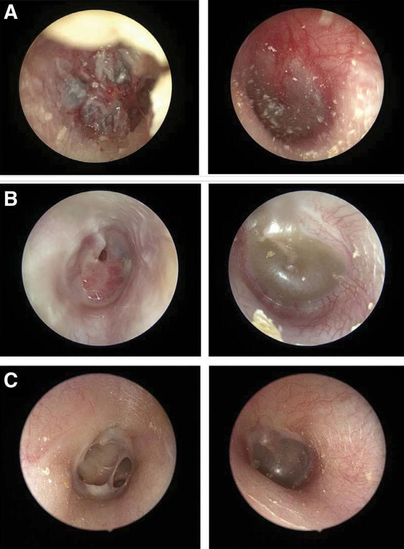 This set of endoscopic otoscopy images documents the bilateral progression and resolution of otitis media. Panel A illustrates acute hemorrhagic otitis media in the right ear with white epithelial thickening and a small perforation, while the left ear shows diffuse hyperemia of the tympanic membrane (TM). Panel B demonstrates the suppurative stage in the right ear with a central TM perforation visible after debridement of purulent material; the left ear shows otitis media with effusion (OME), characterized by a retracted TM and amber-colored middle ear fluid. Panel C shows the chronic phase, with a persistent dry perforation in the right TM lacking acute inflammatory signs, and a resolving or stable state in the left ear. This clinical sequence provides a visual comparison between different stages of inflammatory middle ear disease, including acute infection, suppuration, and persistent perforation, essential for otolaryngology and pediatric diagnostic training.